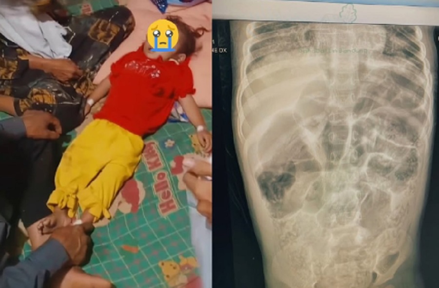 cacingan anak - ilustrasi berita Cacingan Anak: Ancaman pada Pertumbuhan yang Harus Segera Ditangani